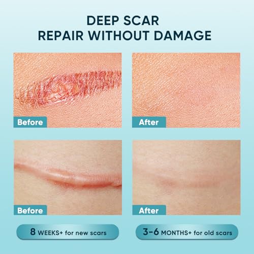 Scar Gel for Surgical, Keloid, Burn & Acne Scars - Hydrating & Skin Repair, 1.7oz