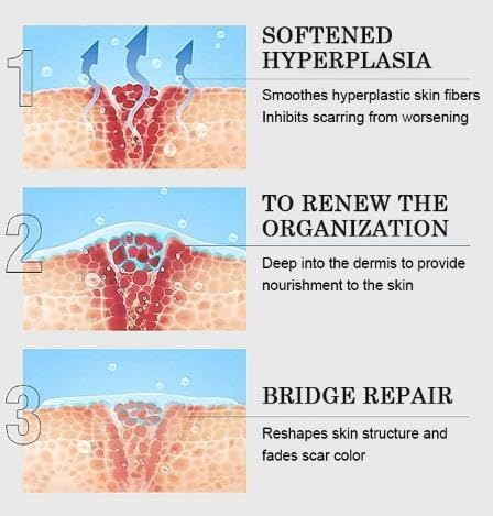 Scar Cream Silicone Gel for Surgical & Keloid Scars - 1 PCS