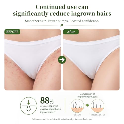 Ingrown Hair Treatment Oil for Sensitive Skin - Prevents Bumps & Razor Irritation