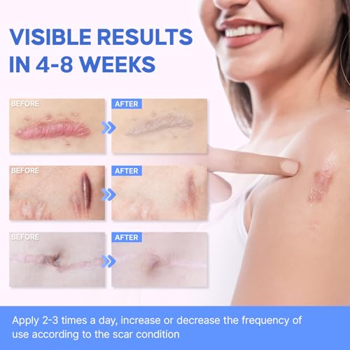 Medical Grade Silicone Scar Gel for Old & New Scars - Fade & Flatten, 30g with 2 Sheets