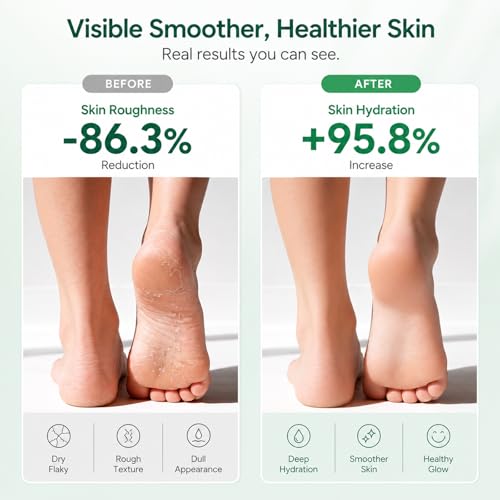 Urea Cream 40% for Feet - Maximum Strength Callus & Dry Heel Relief - 6 OZ Pack of 2