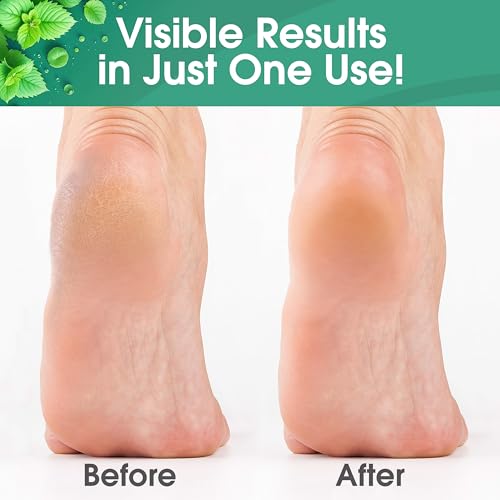 Foot Callus Remover Kit with Mint Gel, Rasp & File for Home Pedicure