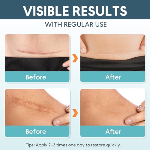 Silicone Scar Sheets for Keloid & Surgical Scars - 10 Pack