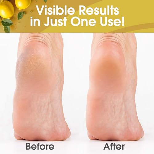 Callus Remover Gel for Feet - Lemon Scent, 16oz, Professional Pedicure Formula with Cone Cap