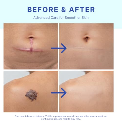 Silicone Scar Removal Stick for Face & Body - Keloid, Acne, C-Section, Stretch Marks - 20g