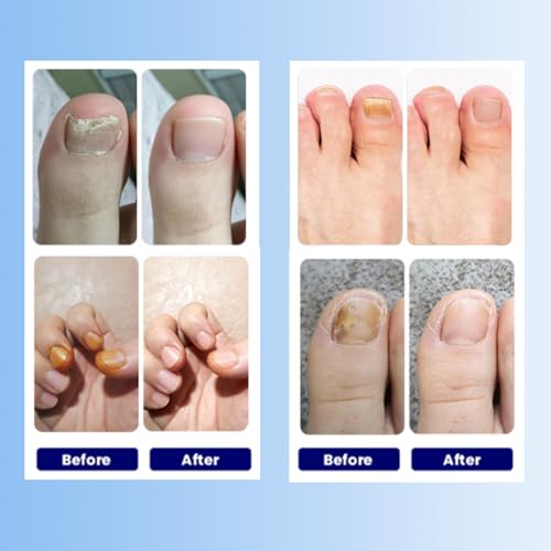 Toenail Fungus Treatment Extra Strength - 21 Pcs Fungal Nail Patches, Foot Nails Repair & Strengthen Patches for Women & Men (1 Count (Pack of 21))