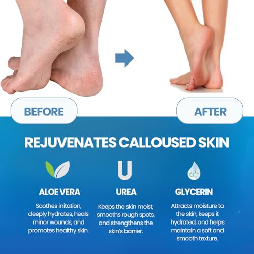 Imperial Feet Callus Remover Set with Spray & File - Dry Cracked Heel Care