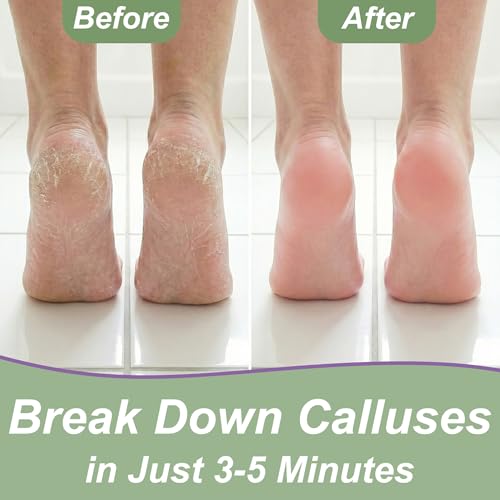 16 oz Extra Strength Callus Remover Gel for Feet - Professional Foot Care