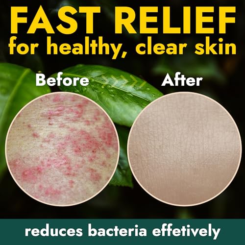 Antibacterial Body Bar Soap with Scrubber for Back Acne & Body Odor - 2 Pack