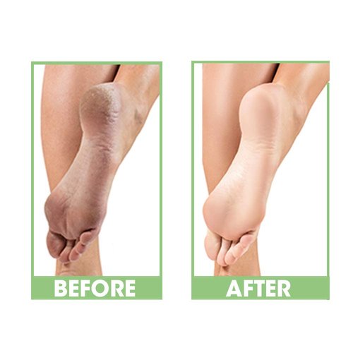 ProLinc Dry Heel Eliminator - Hydrate & Protect Dry Heels | Fast Absorbing, Non-Greasy | 4 Fl. Oz