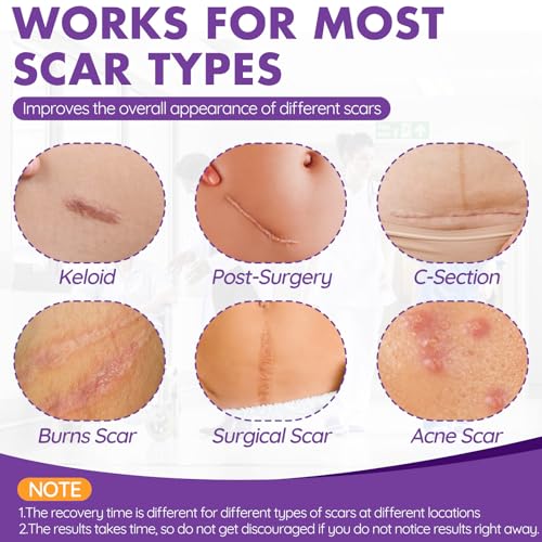 Silicone Scar Sheets Roll - 2M Reusable Soft Silicone Tape for Surgical & Keloid Scars