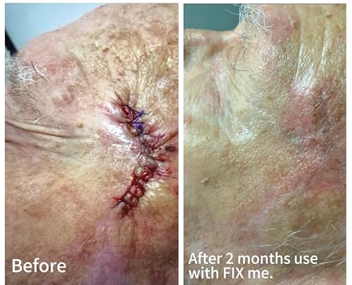 Advanced Scar Cream for Scar Reduction - Dermatologist Developed 0.5 oz