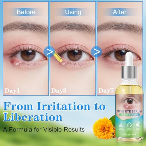 Stye Eye Relief Serum Natural Eyelid Drops for Styes Blepharitis & Chalazion Fast-Acting Relieve Eye Irritation Redness & Swelling Gentle Formula 1.01 Fl oz/30 Ml