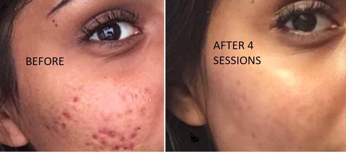 TCa 100% Peel - Medium Depth Chemical Peel for Scars | 0.3oz/10ml - Ideal for Aestheticians & DIY Skincare