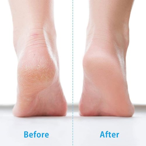 Skiennix Foot File - Stainless Steel Callus Remover for Professional Pedicure | Ideal for Wet & Dry Feet
