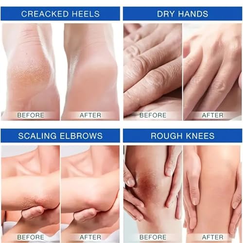 Urea Cream 45% Plus 2% Salicylic Acid Foot & Hand Moisturizer - 1.75 Fl Oz