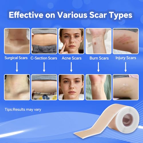 Reusable Silicone Scar Tape 1.5M - Skin Healing & Scar Minimize