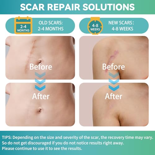 Reusable Silicone Scar Sheets for Face & Body - Medical Grade, 1.6x60 Inch Roll