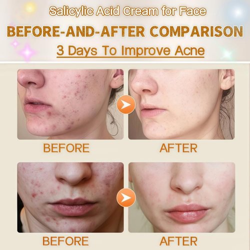 Salicylic Acid Acne Treatment Face Cream by [Brand Name] - Oil Control & Pore Refining, 50ml / 1.69oz (2 Pack)