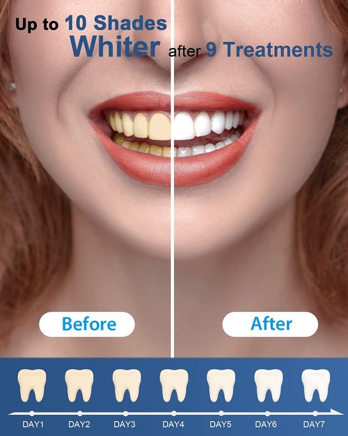 MySmile Teeth Whitening Gel Pen Refill Pack, 3 Non-Sensitive Teeth Whitening Pen, Deluxe Teeth Whitener Dental Grade Tooth Whitening Gel with Carbamide Peroxide for Home, Fast Result