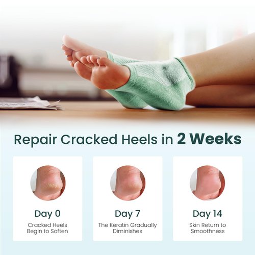 Moisturizing Heel Socks for Cracked Heel Treatment - Promifun 2 Pairs Moisturizer Socks - Heel Socks for Dry Cracked Feet - Cracked Heel Repair - Heel Socks for Women & Men (Gray & Green)