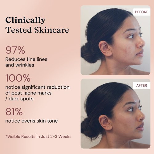 ADM Anti Aging Pure Retinol Serum For Face with Niacinamide - Resurfacing, Smoothing Fine Lines, Wrinkles, Acne Scars - Moisturizing Facial Skincare Treatment for Sensitive Skin - 1oz