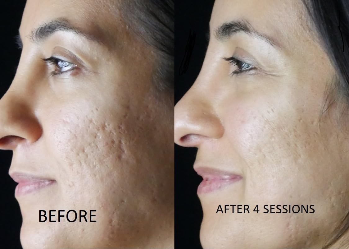 TCa 100% Peel - Medium Depth Chemical Peel for Scars | 0.3oz/10ml - Ideal for Aestheticians & DIY Skincare