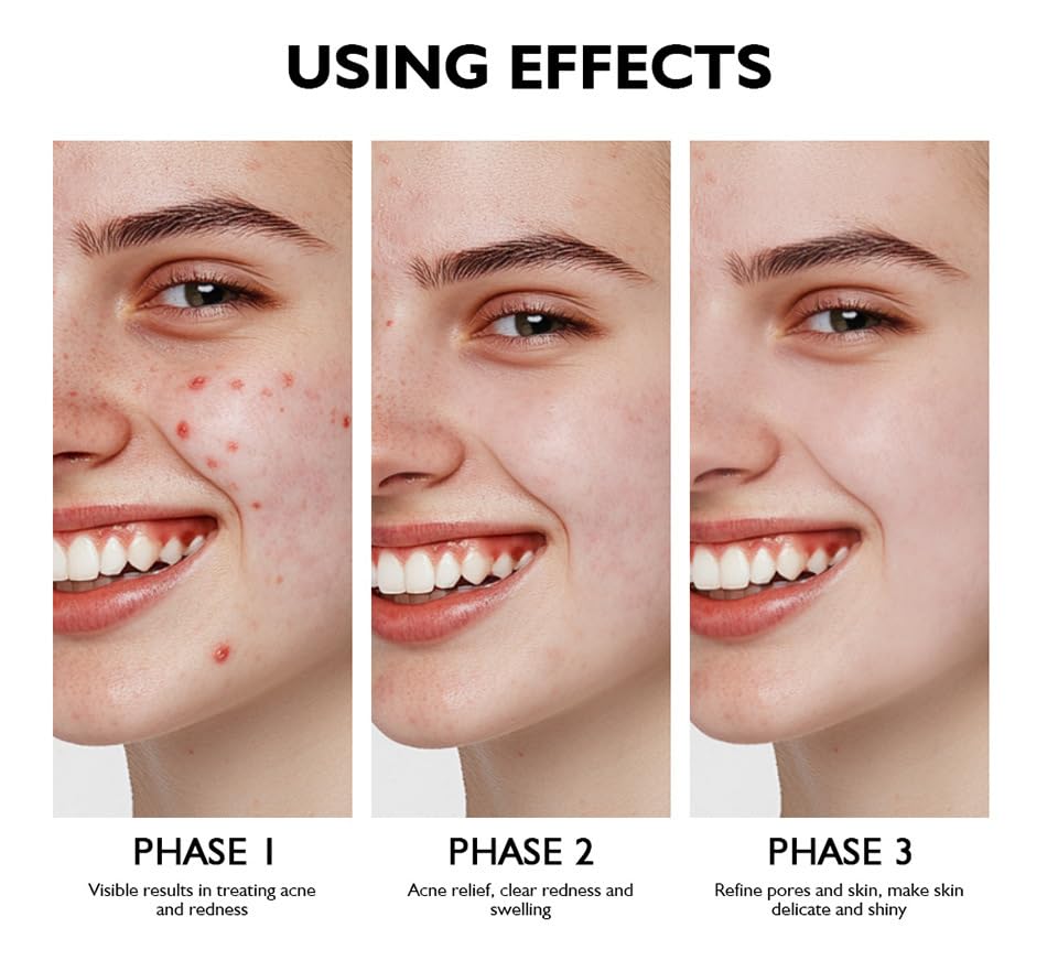 Azelaic Acid Serum by [Brand Name] - Acne Treatment with 10% Azelaic & Salicylic Acid | 30ml for Sensitive Skin