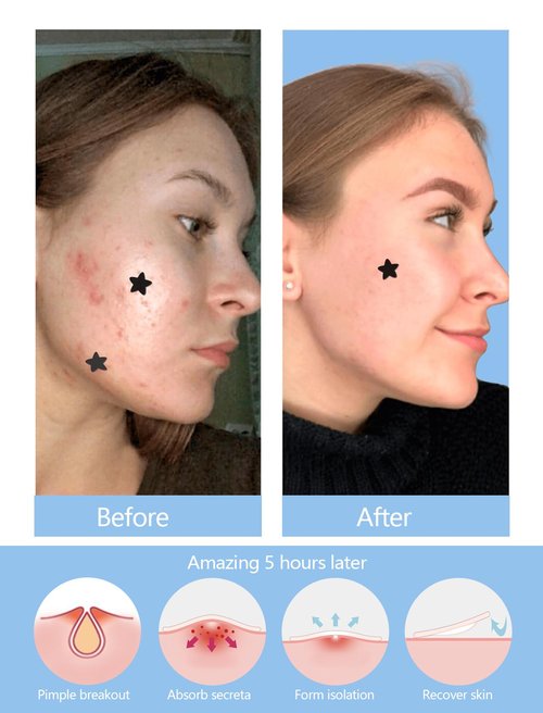 Black Star Pimple Patches for Face, 153 Counts Hydrocolloid Star Acne Patches, Cute Zit Covers for Face, Spot Stickers with Tea Tree, Salicylic Acid and Cica Oil