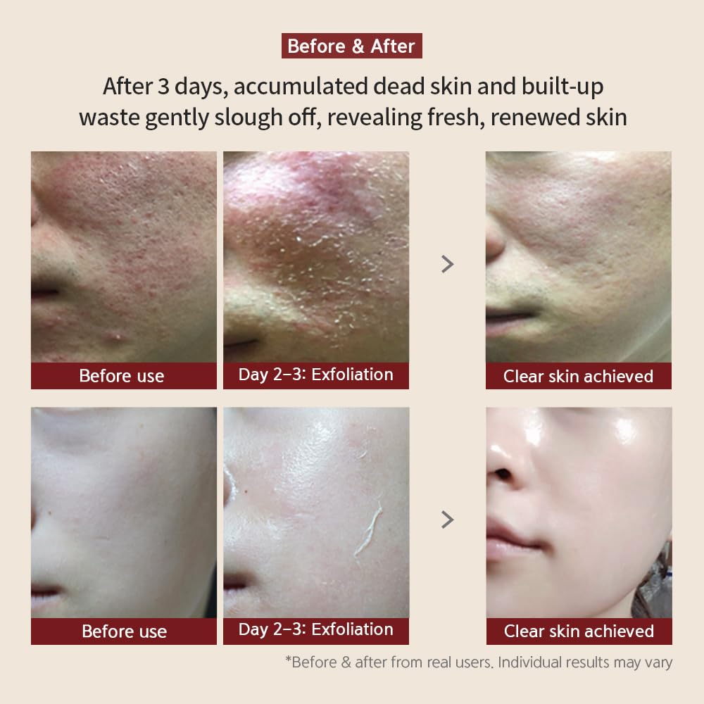 [BQCELL] [Made In Korea] [DERMA SKIN PEELING 2g / Recell Cure Serum 2ml, Safety Cap 1ea, 3set], Acne Skin Available, Exfoliating, Facial Scrub, Korean Beauty, Blackhead Remover