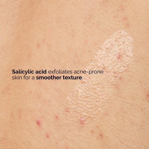 The Ordinary Salicylic Acid 0.5% Body Serum, Exfoliating Treatment for Acne-Prone Skin, 8.1 Fl Oz