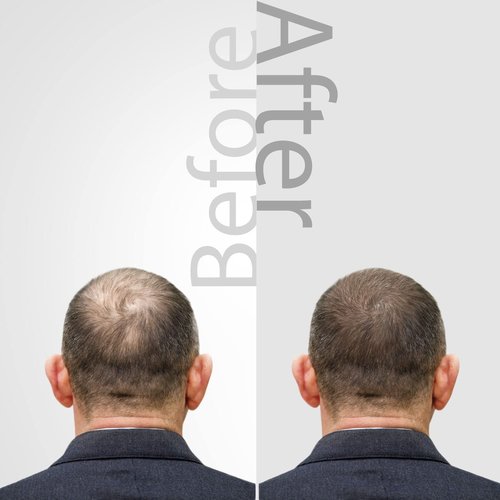 The Mossi London Ozonized Scalp Oil, Hair growth Complex, Hair oil for Dry Scalp, Hair Growth oil For Man, Woman, Scalp Treatment, All Hair Types (1.01 fl Oz. - 30 ml)