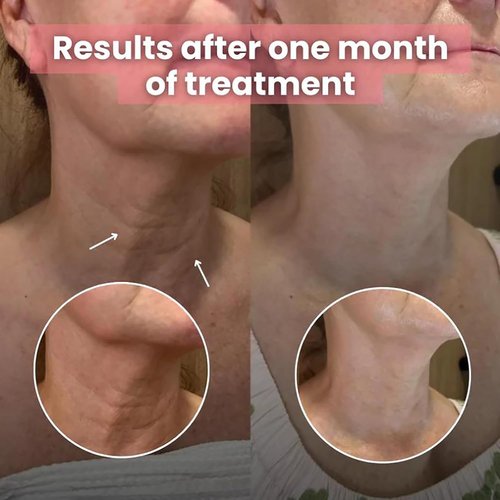 **Korean Bio-Collagen Necklift Mask - Hydrating & Firming Silicone Wrinkle Patches for Youthful Neck (2 Pack)**