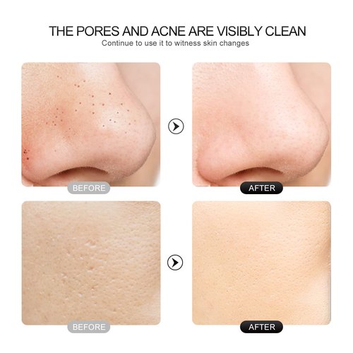Face Scrubber Skin Spatula - Blackhead Remover with 4 Modes, Pore Extractor Face Spatula Deep Cleansing for Facial Skincare Women Gift