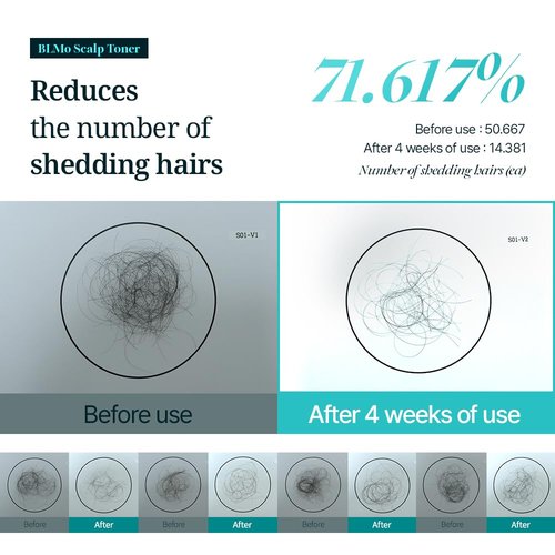 Scalp Serum for Hair Loss & Thinning with Massaging Tips | Clinically Proven | Thickens & Accelerates Hair Growth | Supports DHT Balance | Korean Hair Care | Low Irritation, Drug-Free | 4.05 fl.oz