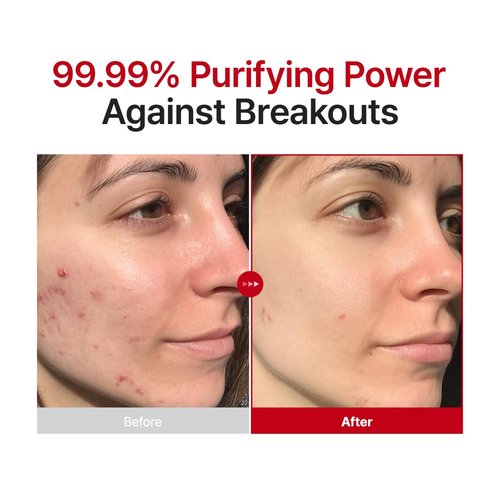 PURITO Hypochlorous Acid Facial Spray | Witch Hazel 5% + Forest Breeze | HOCl Facial Mist for Sensitive, Redness-Prone Skin | Refreshing Toner Mist | Korean Skincare, 100mL / 3.38 fl.oz