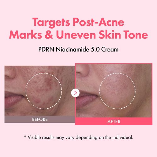 TOSOWOONG PDRN Niacinamide 5.0 Cream, Niacinamide 5% Dark Spot Remover for Face, Hyperpigmentation & Blemish Care, Salmon DNA Hydrating Moisturizer, Korean Skincare, 50ml / 1.69 fl. oz.