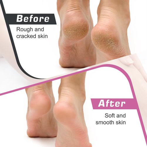 Electric Foot Callus Remover,Callus Remover for Feet,with 60pcs Sanding Disc,Electric Speed Adjustable Foot File for Dead Skin Cracked Skin Calluses for Men and Women