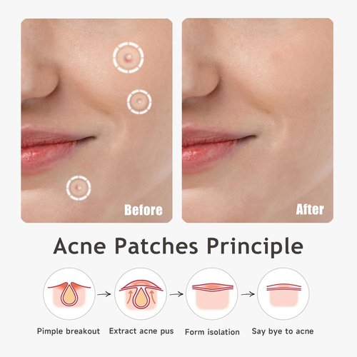 Dazzlook Ultra Pimple Patches Large Pack, Invisible Hydrocolloid Zits Blemishes Absorbing Patch with Tea Tree Oil Centella Asiatica, Pimple Dots Stickers, 168 Patches for Family Use