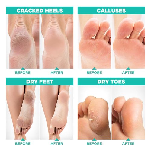 Lavinso Foot Peel Mask for Dry Cracked Feet – 4 Pack Peeling Mask Removes Dead Skin and Calluses - Exfoliating for Soft Baby Feet, Original Scent