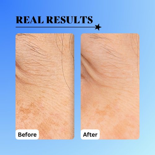 10% Glycolic Treatment Tonic Exfoliating Toner for Face and Body, Alcohol Free, Combats Acne and Hyperpigmentation, Rough Skin, All Skin Types Including Sensitive