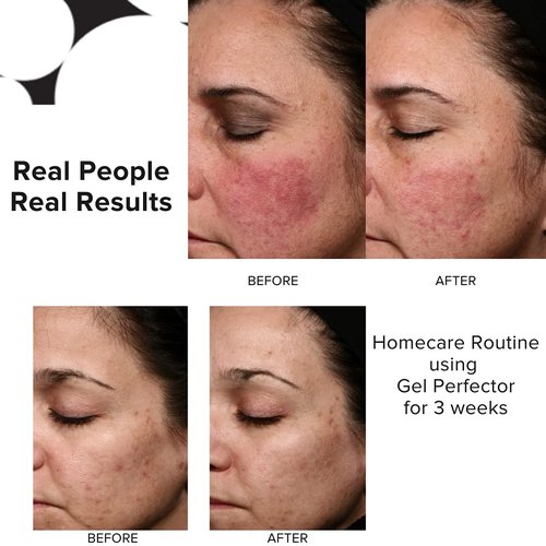 PRIORI Skincare Gel Perfector - Acne Treatment for Oily Skin | Oil Control with Salicylic & Lactic Acid, 1 fl oz