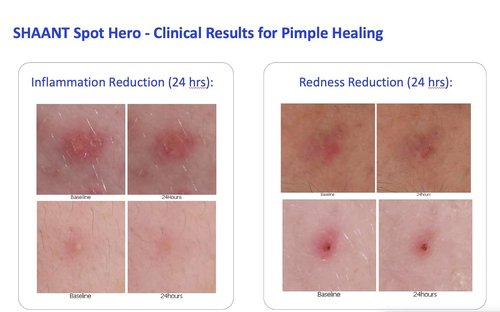 Codex Labs Shaant Spot Hero – 5% Sulfur Acne Spot Treatment | Clinically Tested for Sensitive Skin | 0.5 oz