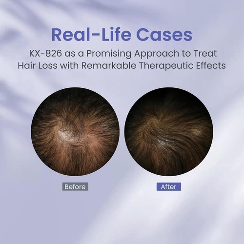 KINTOR Hair Regrowth Spray 0.9% KX-826 - Supports Healthy Hair Growth & Oil Control | 60ml