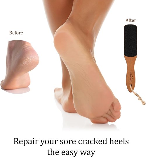 Skiennix Foot File - Double-Sided Pumice Stone Callus Remover for Dry Skin & Cracked Heels
