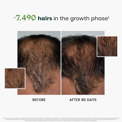 Rene Furterer Triphasic Serum for Hormonal Thinning Hair - Drug-Free Leave-In Treatment | 30-Day Supply