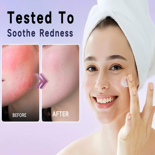 Cystic Acne Treatment for Face – Hormonal Acne Spot Treatment Pimple Cream with Azelaic Acid | Redness Reducing Acne Moisturizer for Rosacea & Sensitive, Acne-Prone Skin | Teens & Adults, 1.7 oz