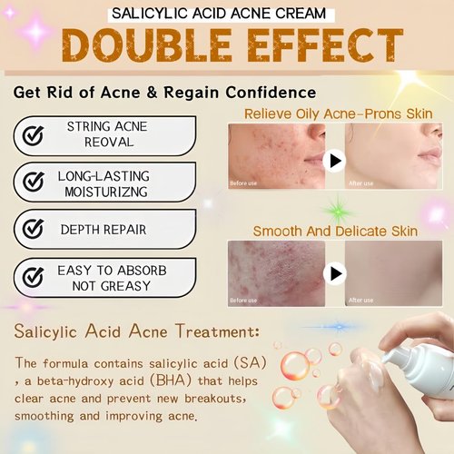 Salicylic Acid Acne Treatment Face Cream by [Brand Name] - Oil Control & Pore Refining, 50ml / 1.69oz (2 Pack)