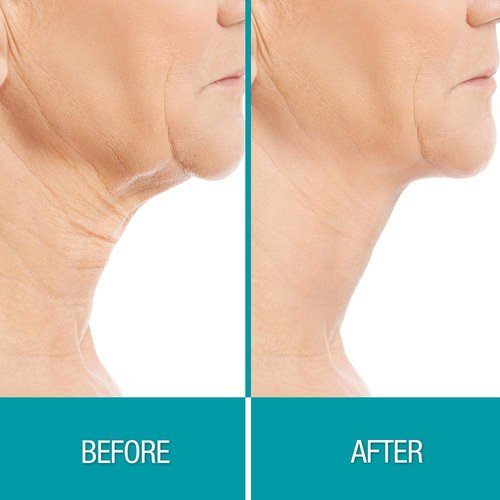 Dermactin-TS Collagen Chin Mask - Skin Firming Treatment | 0.35 Ounce Packette