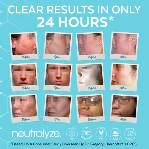 Neutralyze Exfoliating Acne Treatment Wipes - Maximum Strength, Textured Acne Pads with Mandelic Acid & Salicylic Acid for Face & Body - Suitable for All Skin Types, Teens & Adults (100 Wipes)